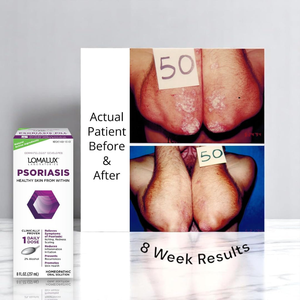 8 oz Psoriasis & Seborrheic Dermatitis Relief Z539009